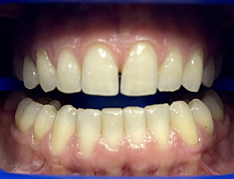 teeth whitening cardiff
