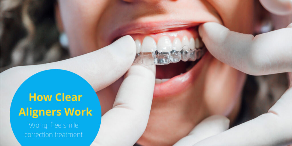 MS Dental - Clear Aligners Work