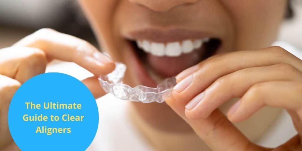 clear aligners