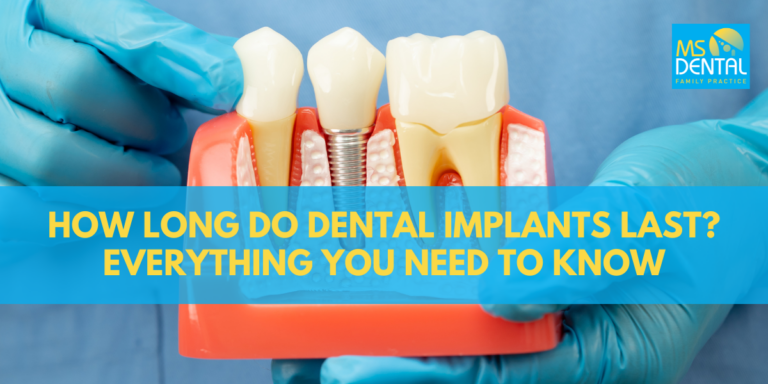 How Long Do Dental Implants Last? Everything You Need to Know