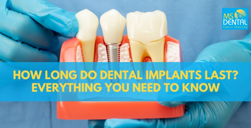 How Long Do Dental Implants Last? Everything You Need to Know