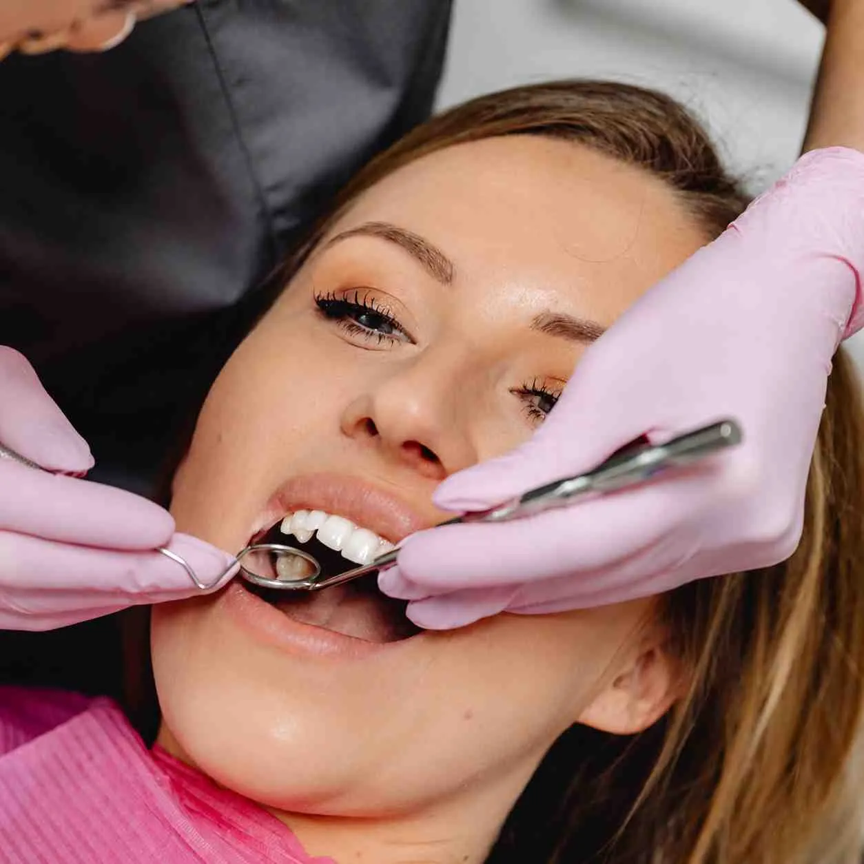 Fillings at MS Dental
