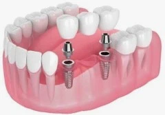 Implant-supported bridge treatment room