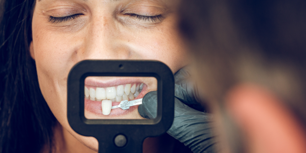 Veneers