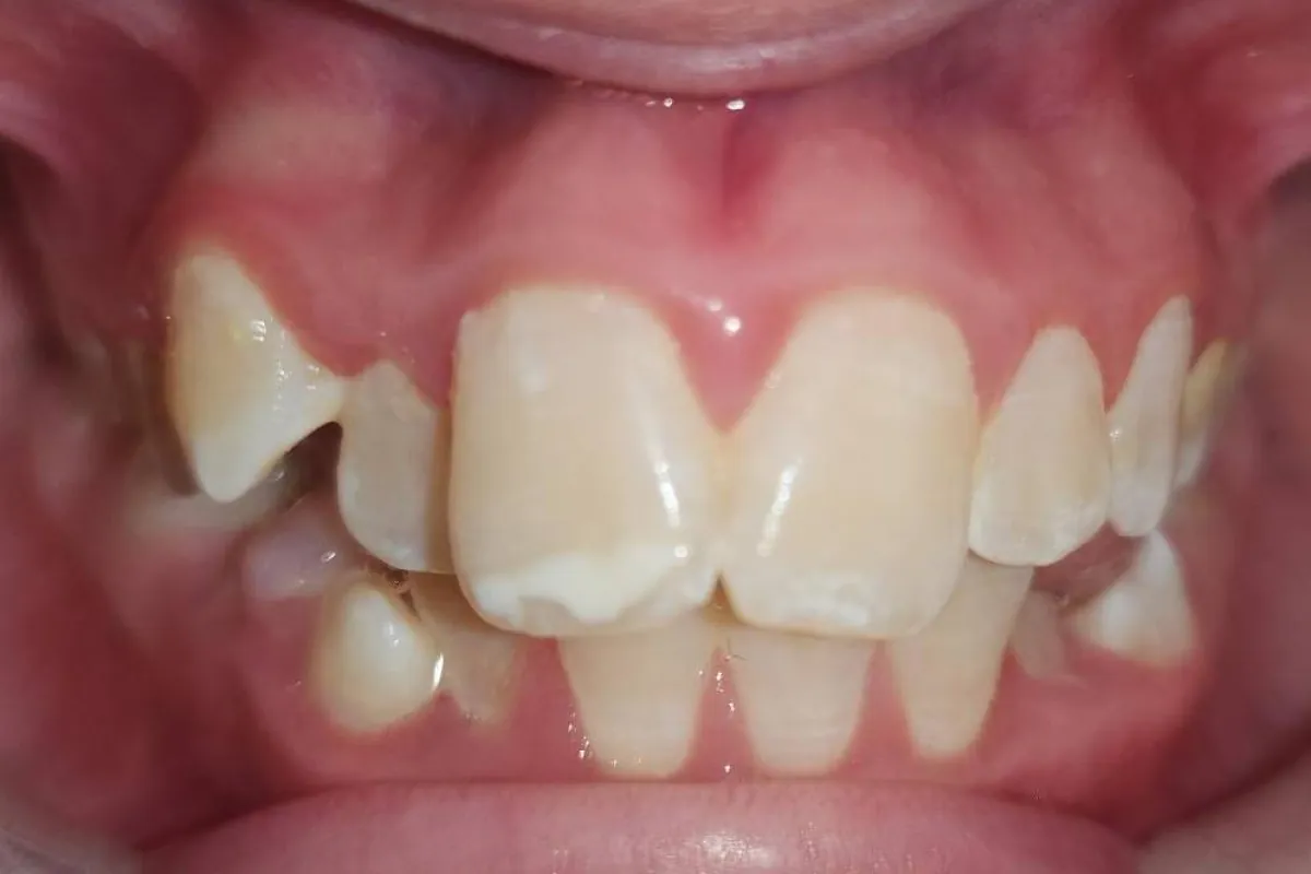 Arch expansion, before: crowded teeth with a canine blocked out high in the gum.
