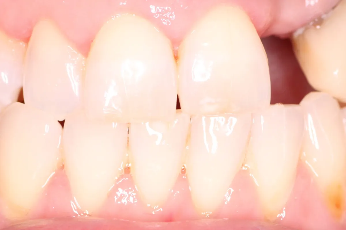 Maryland bridge, before: a gap in the upper front teeth.