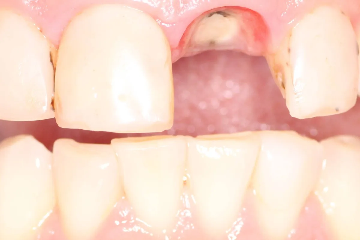 Dental implant, before: a gap in the upper front teeth with the darkened root visible at the gumline.