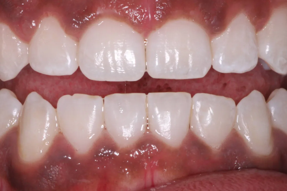 Clear aligners, after: straight, evenly aligned upper and lower teeth.