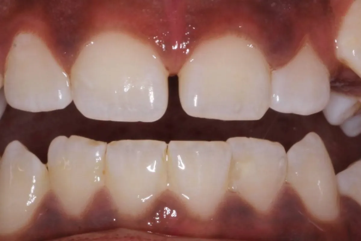 Clear aligners, before: crowded front teeth with rotations and uneven spacing.