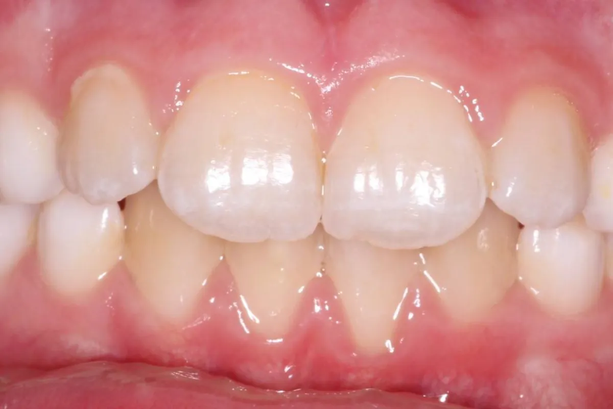 Arch expansion, after: a wider upper arch with the teeth aligned and meeting evenly.