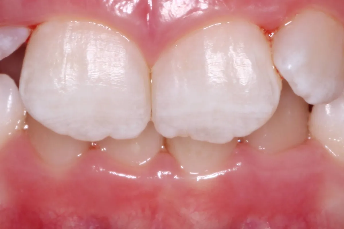 Arch expansion, before: a narrow upper arch with crowded, overlapping teeth.