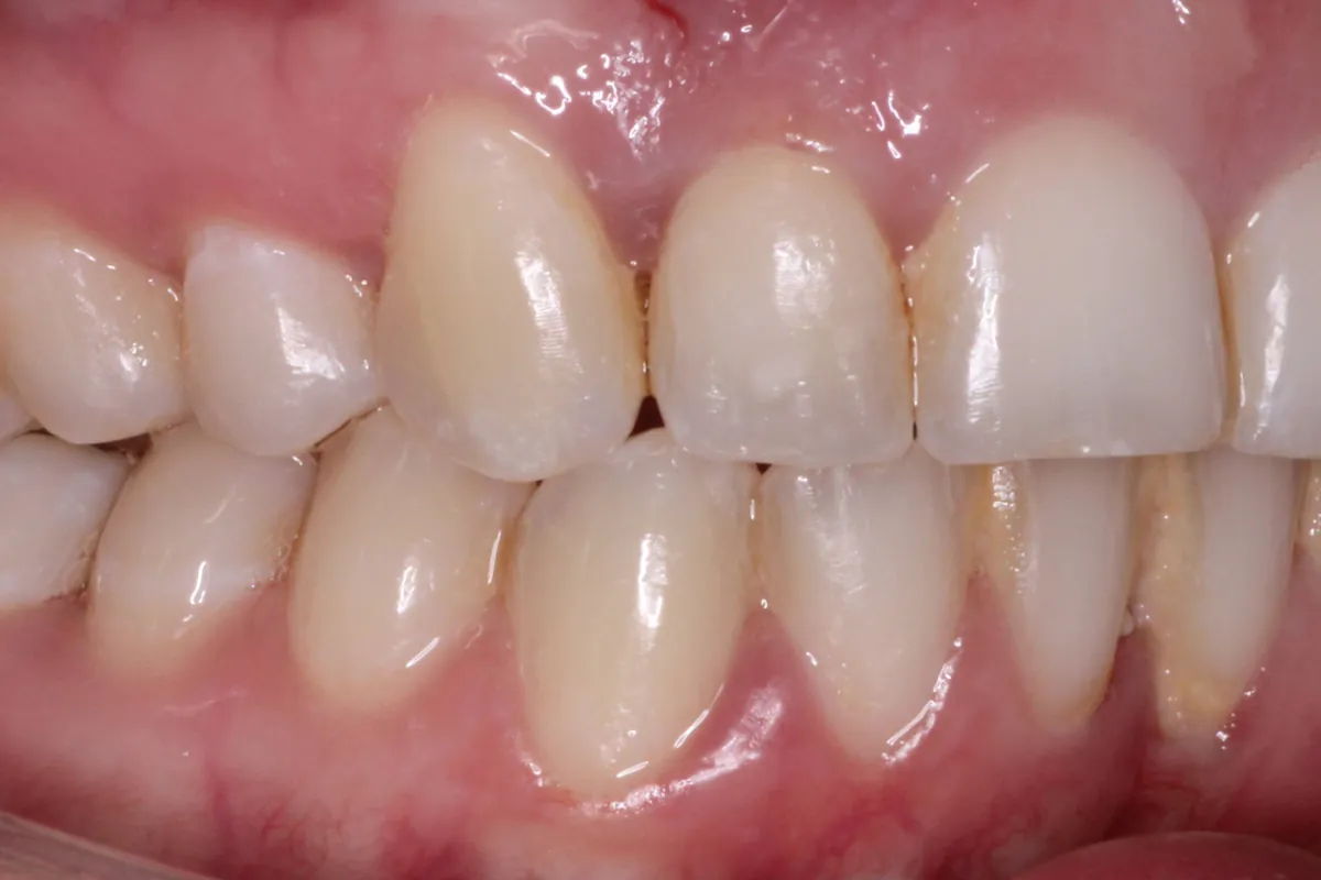 Dental implant, after: side view with the gap filled and the bite even again.