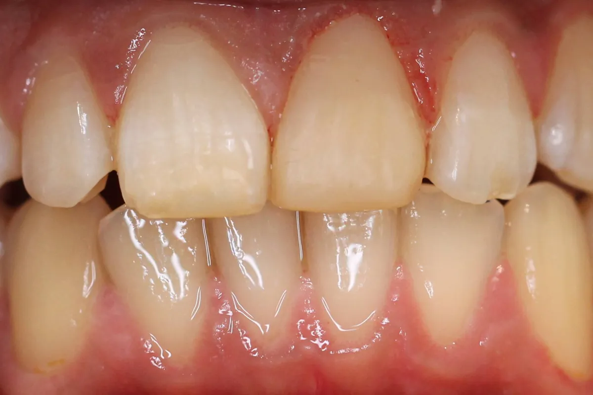 Composite filling, after: the front teeth rebuilt with an even biting edge.