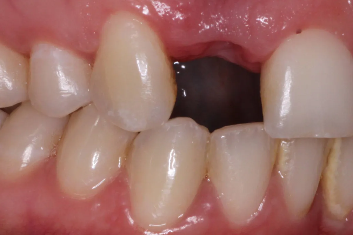 Dental implant, before: side view showing a gap where a back tooth is missing.