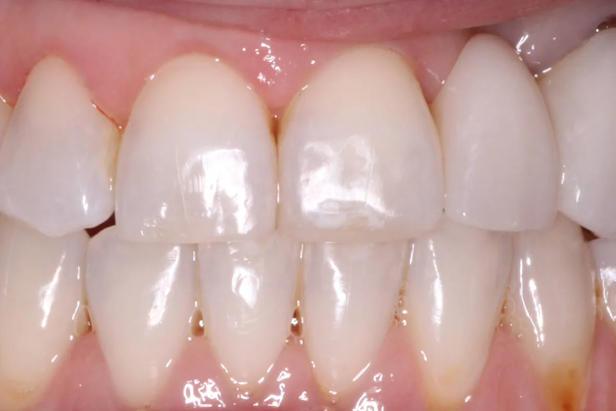 Maryland bridge, after: the gap closed and the bridge blended with the natural teeth.