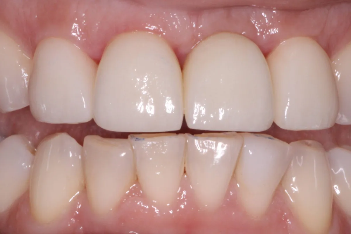 Dental implant, after: the gap closed with a crown that matches the surrounding teeth.