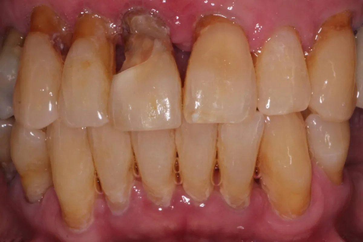 Dental implant, before: a broken tooth at the gumline among worn, stained teeth with gum recession.