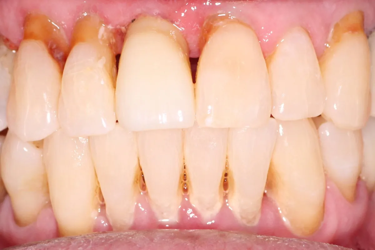 Dental implant, after: the broken tooth replaced with an implant crown, restoring the upper arch.