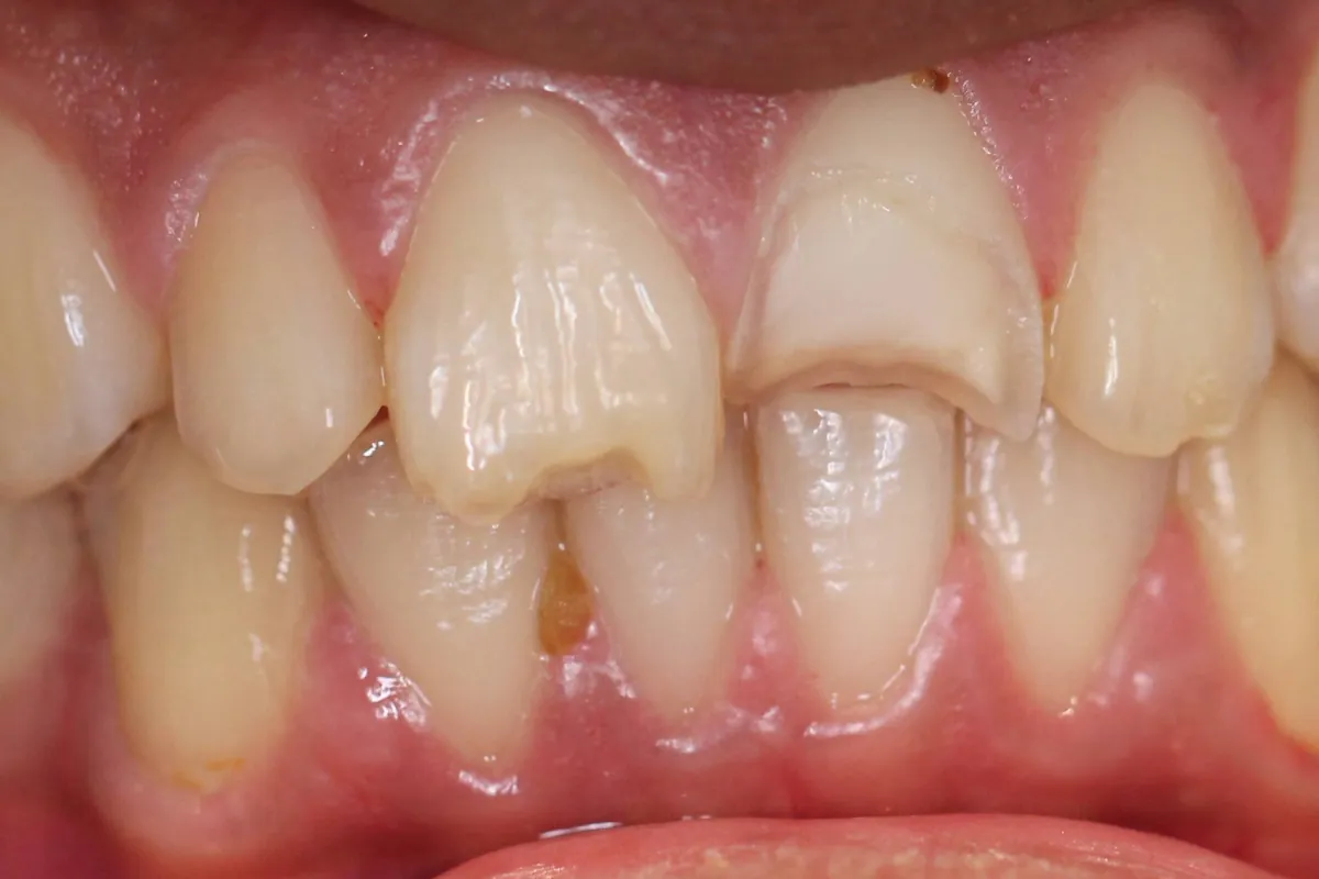 Composite filling, before: chipped and notched upper front teeth with decay at the biting edge.