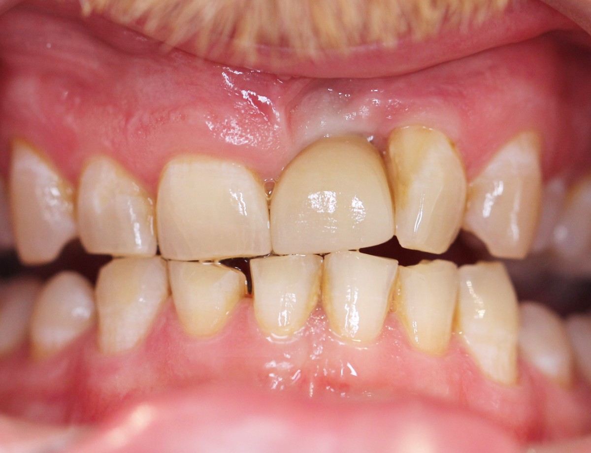 Upper front tooth space before implant treatment