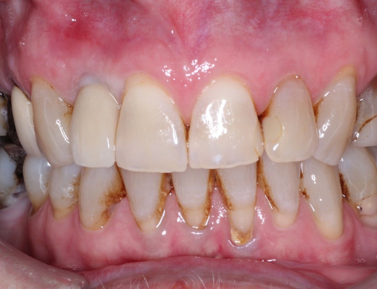 Upper front teeth before treatment