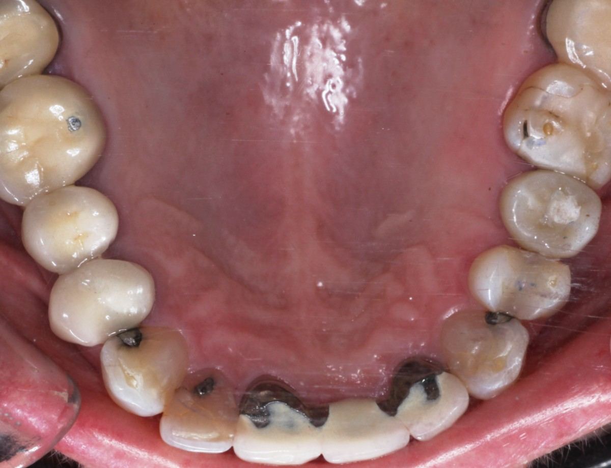Lower arch after treatment