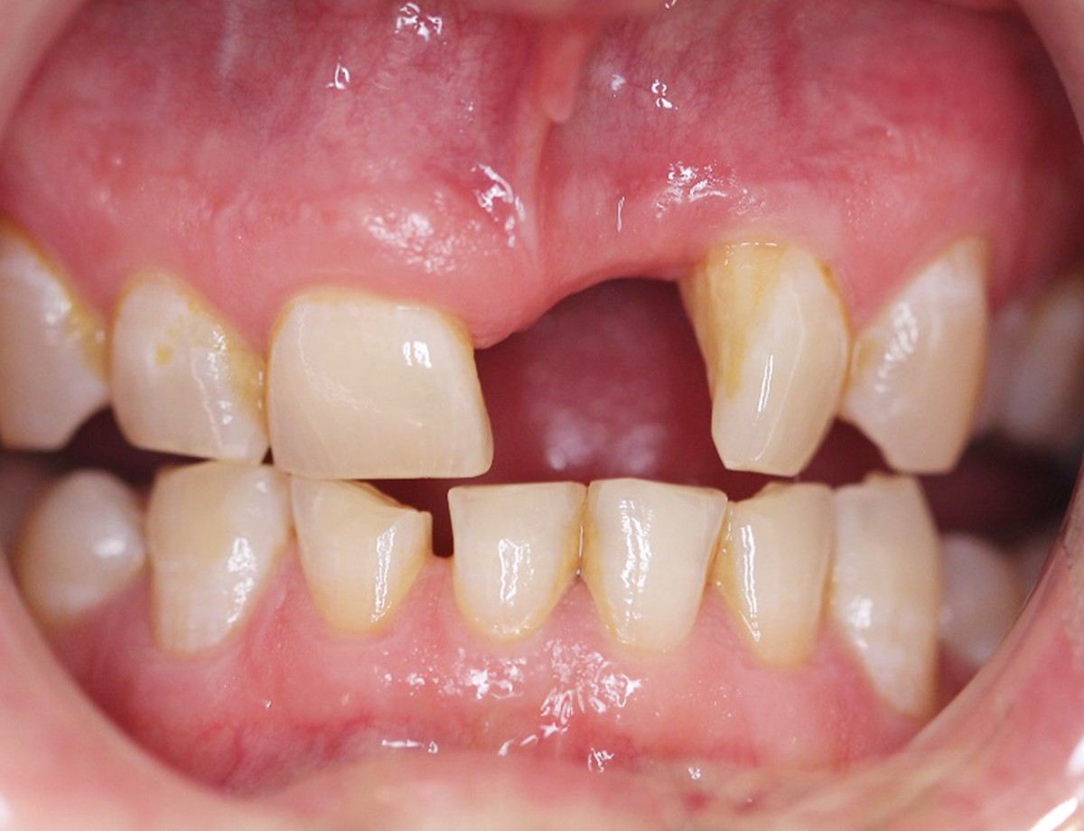 Same upper front tooth space restored with an implant crown