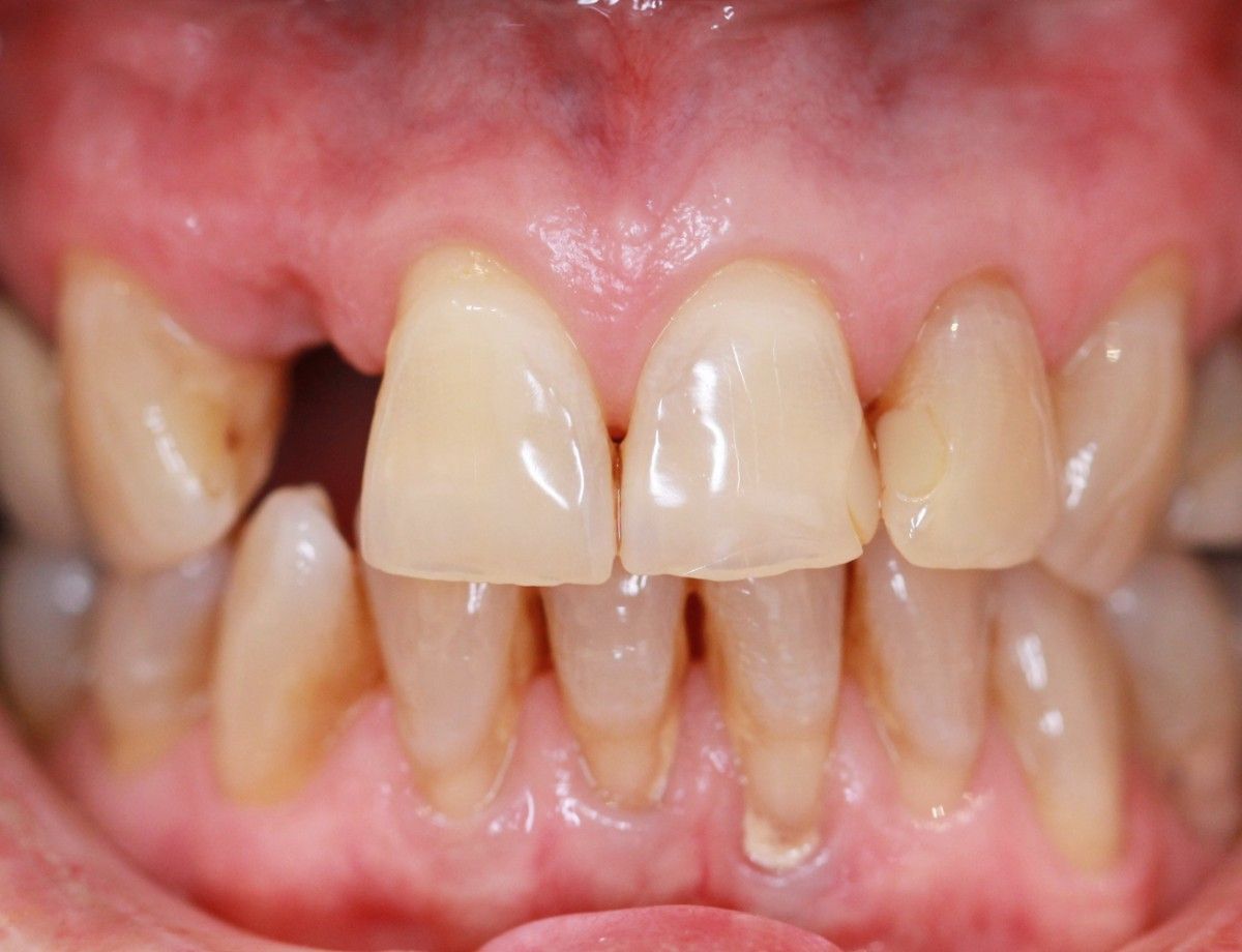 Upper front teeth after treatment