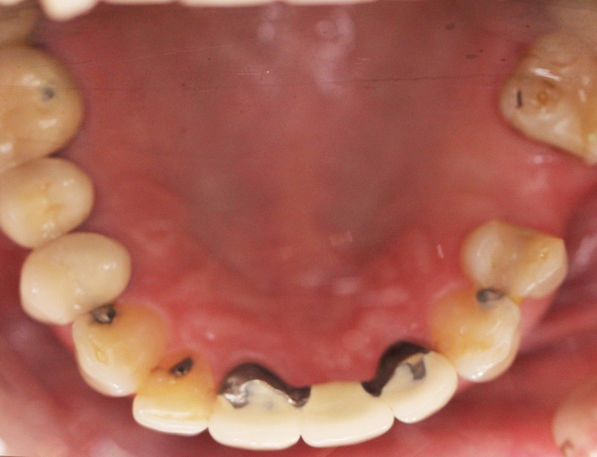 Lower arch before treatment