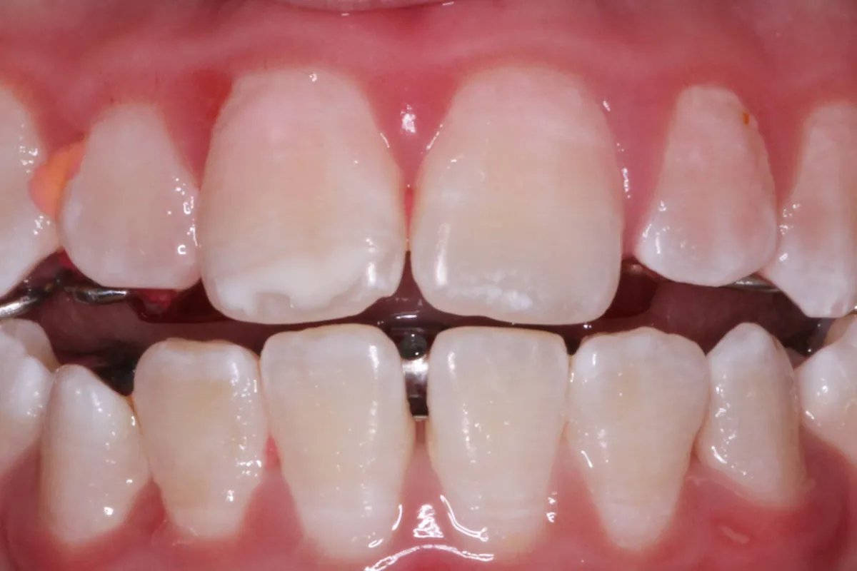 Arch expansion, after: the arch is wider and the teeth are aligned, with the expander still fitted.