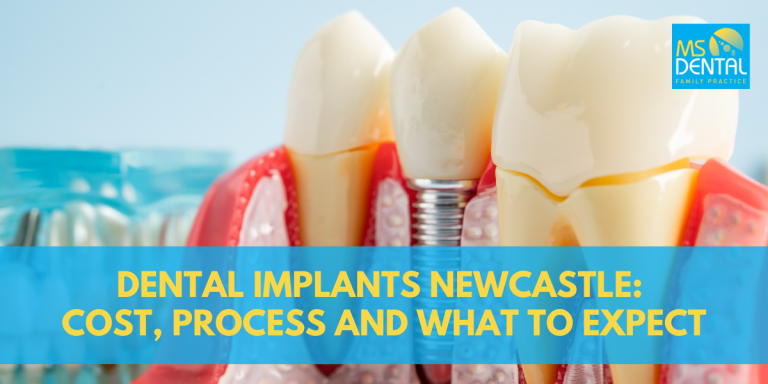Dental Implants Newcastle: Cost, Process and What to Expect